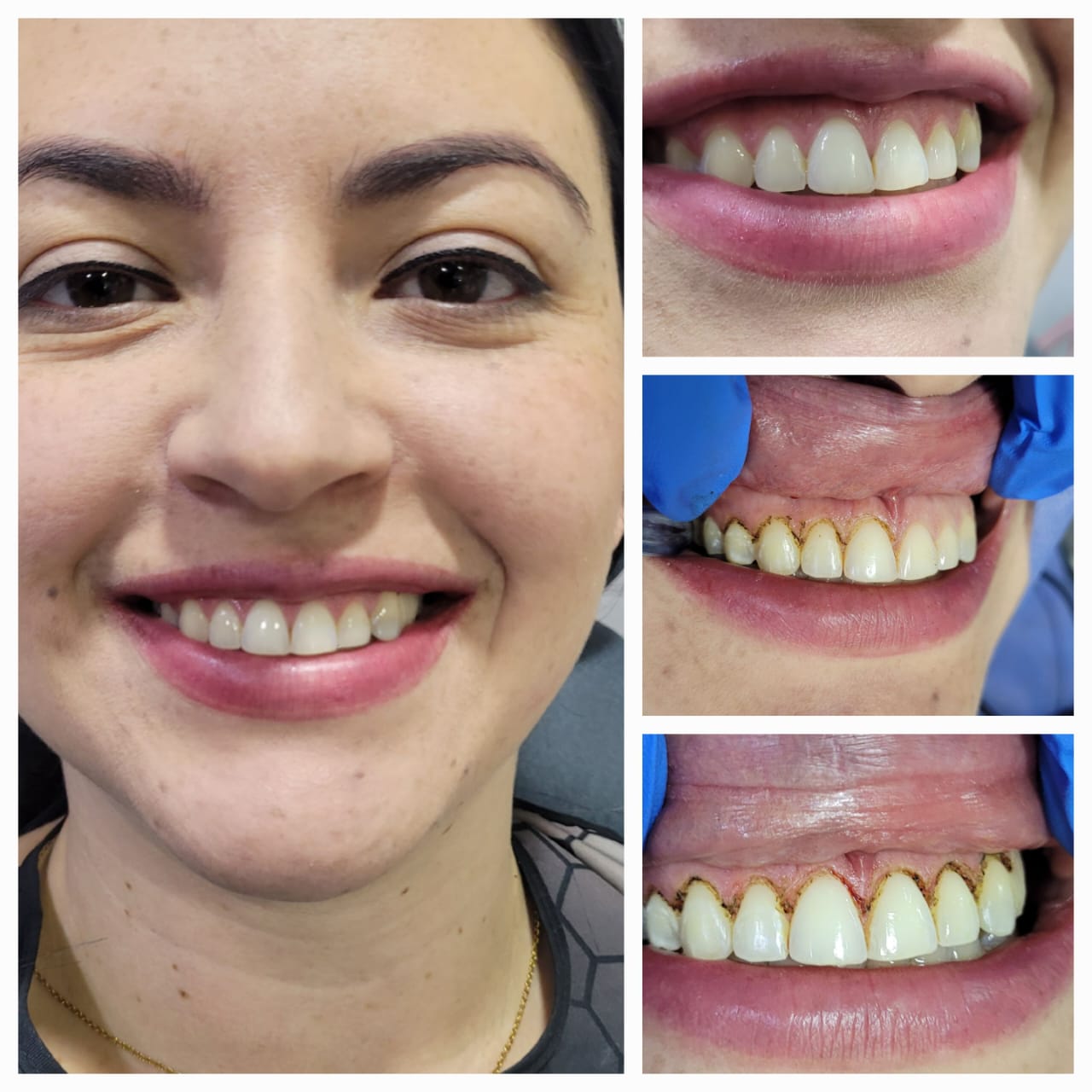 Rehabilitación Estética Completa