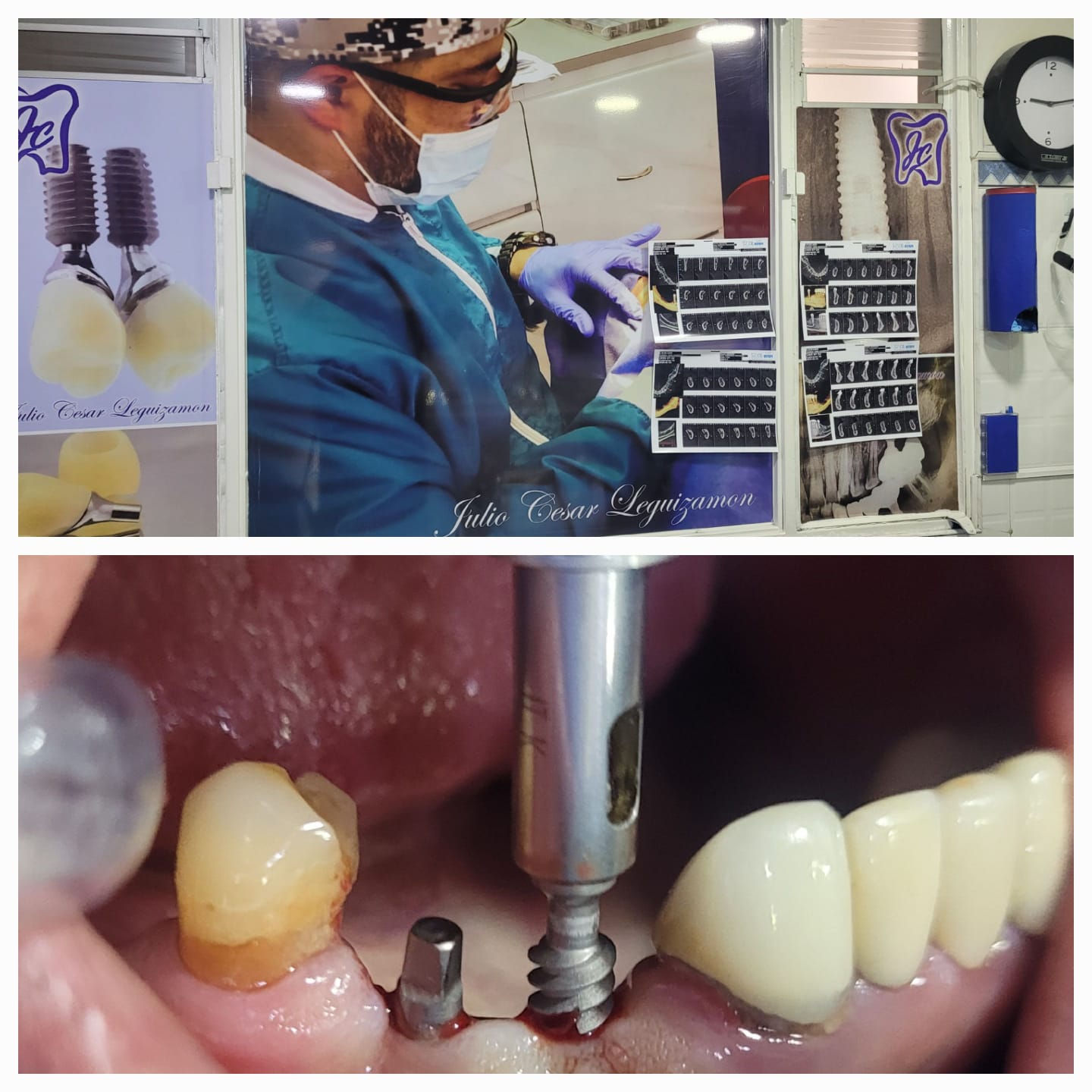 Dr. Leguizamón realizando procedimiento de implante